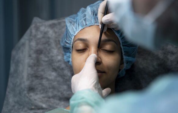 Rhinoplasty